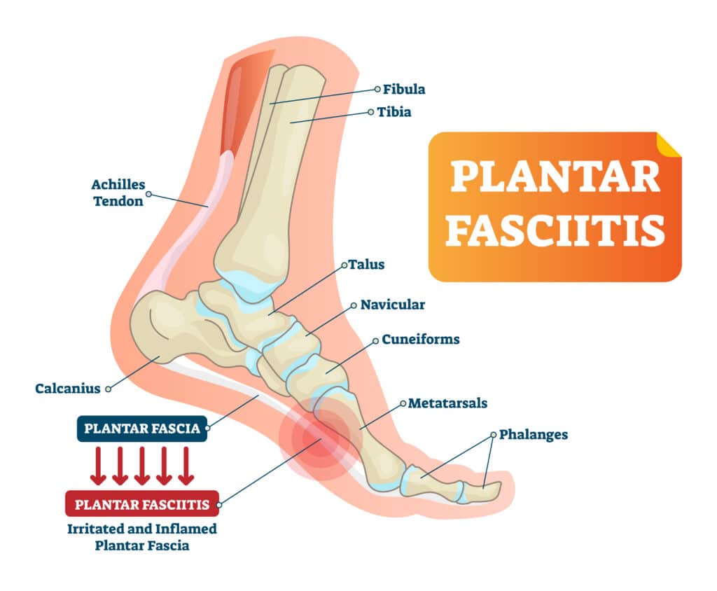 plantar,fasciitis,vector,illustration.,labeled,human,feet,sport,disorder,diagram.