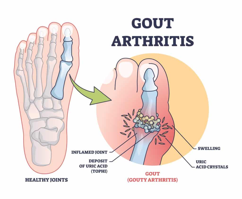 gouty,arthritis,with,inflamed,toe,joint,painful,condition,outline,diagram.