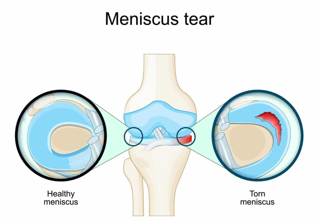 meniscal,tear.,knee,anatomy.,close up,of,torn,meniscus,and,cartilage
