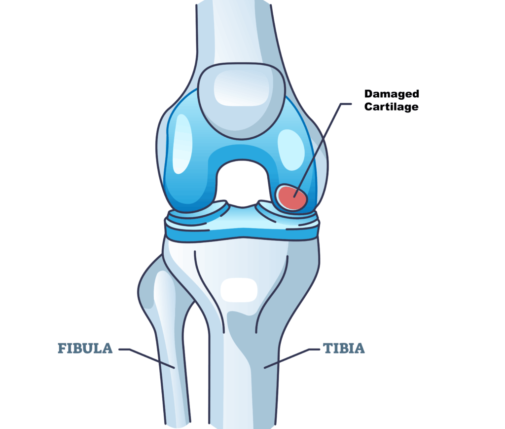 knee-repair-damage - Princeton Orthopaedic Associates
