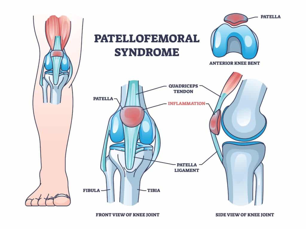 PatellofemoralPainSyndromeAsAnatomicalKneeConditionOutlineDiagramLabeled - Princeton Orthopaedic Associates