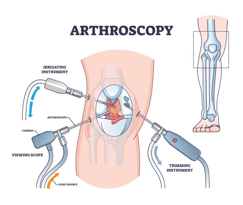 ArthroscopyProcedureProcessExplanationFromMedicalViewOutlineDiagramLabeled - Princeton Orthopaedic Associates
