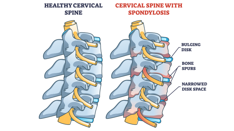 poa-back-bone-spurs-1 - Princeton Orthopaedic Associates