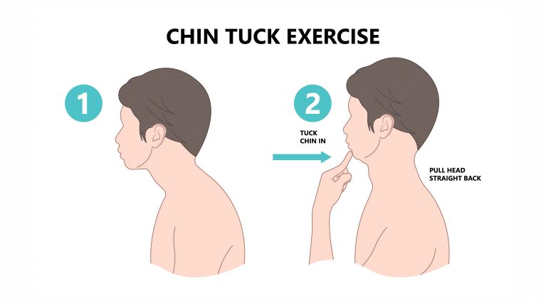 poa-chin-tuck-2 - Princeton Orthopaedic Associates
