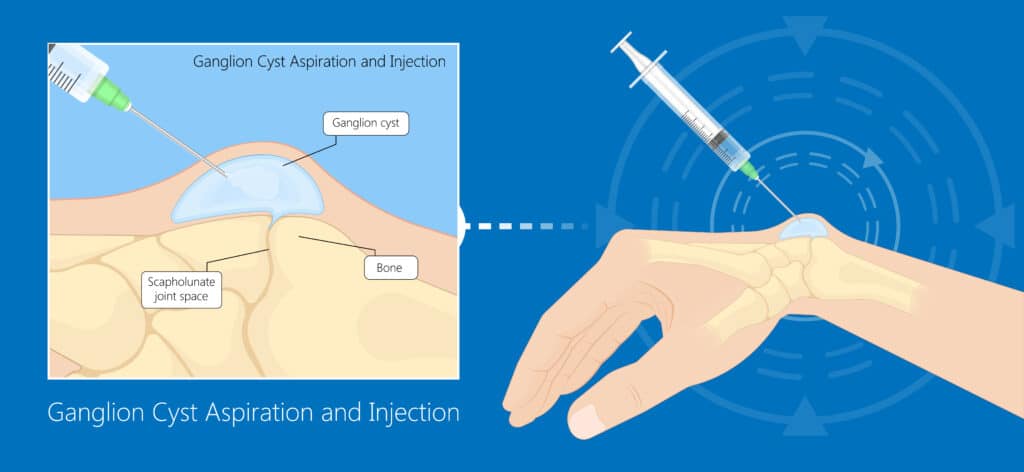 GanglionCystSmallSacOfFluidDiseaseHandWristTrauma - Princeton Orthopaedic Associates