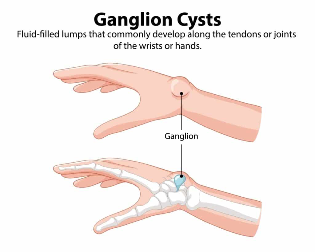 IllustrationOfGanglionCystsOnWristAndHand - Princeton Orthopaedic Associates