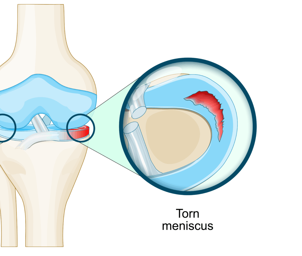 torn-meniscus - Princeton Orthopaedic Associates