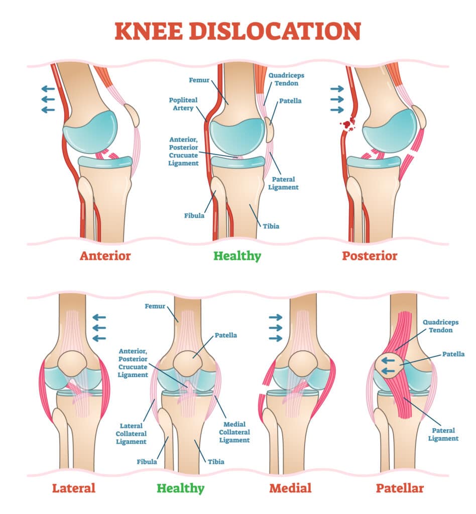 POA-KNEE-DISLOCATION - Princeton Orthopaedic Associates