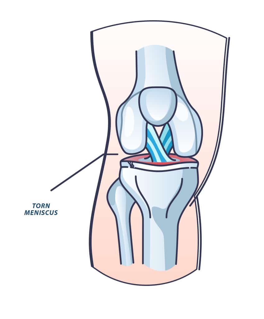 TORN-MENISCUS-POA - Princeton Orthopaedic Associates