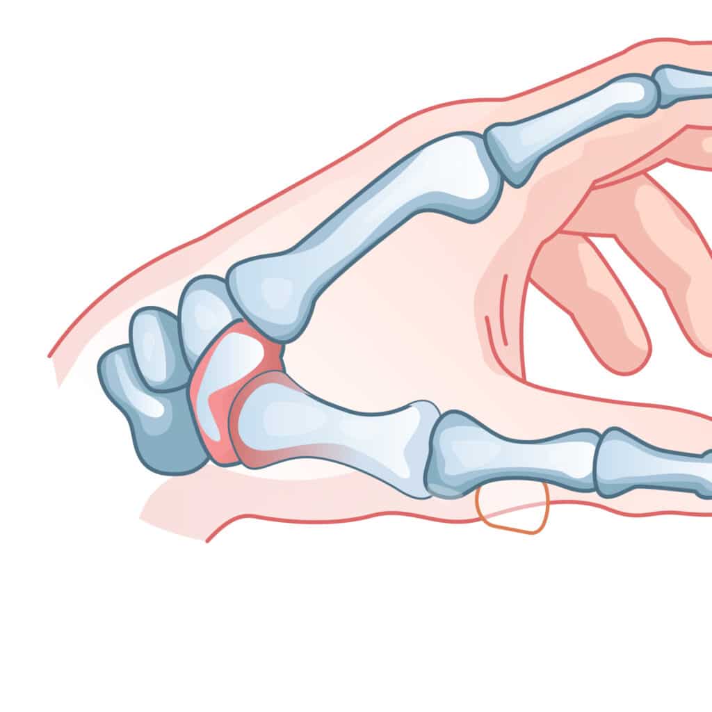 arthiritis - Princeton Orthopaedic Associates