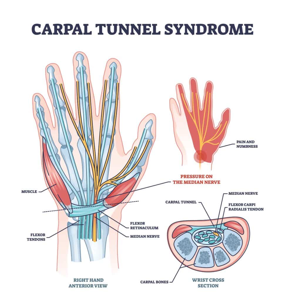 carpal tunnel - Princeton Orthopaedic Associates