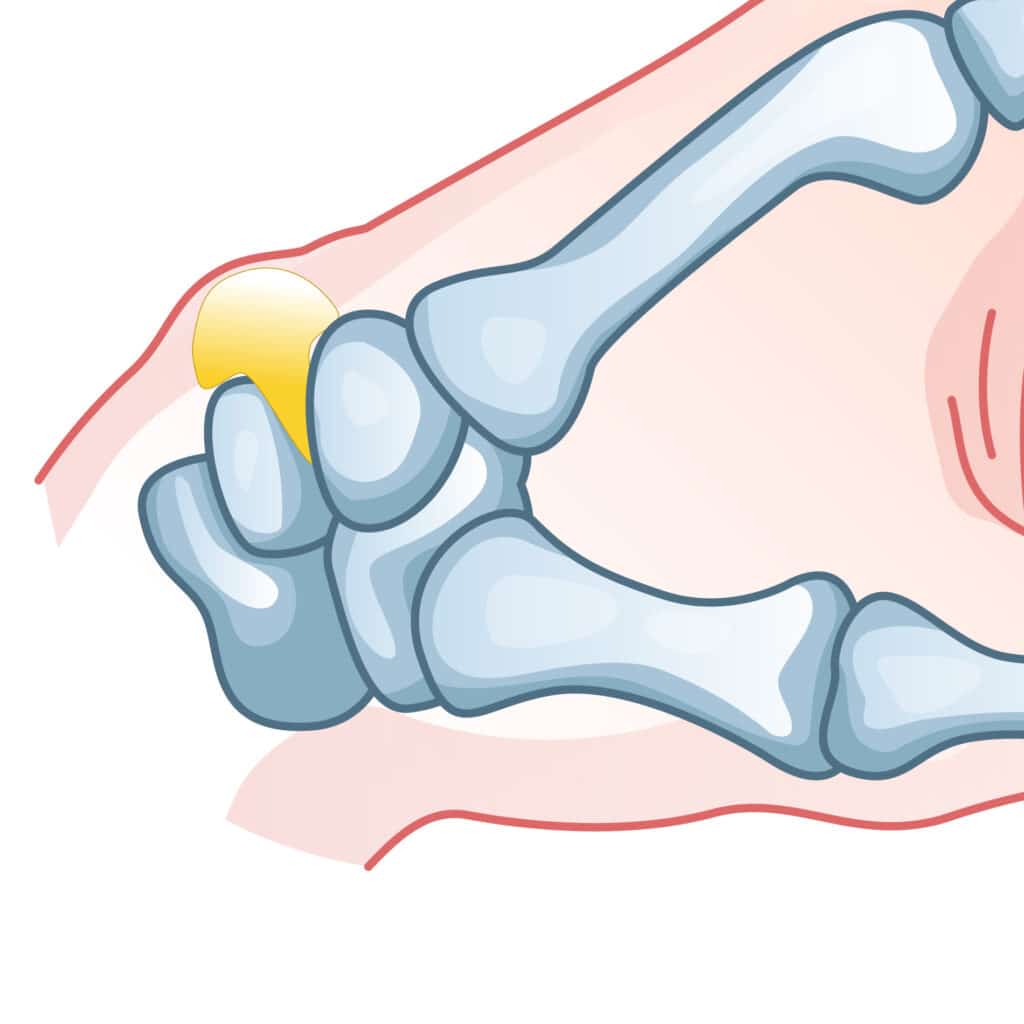 cyst-poa - Princeton Orthopaedic Associates
