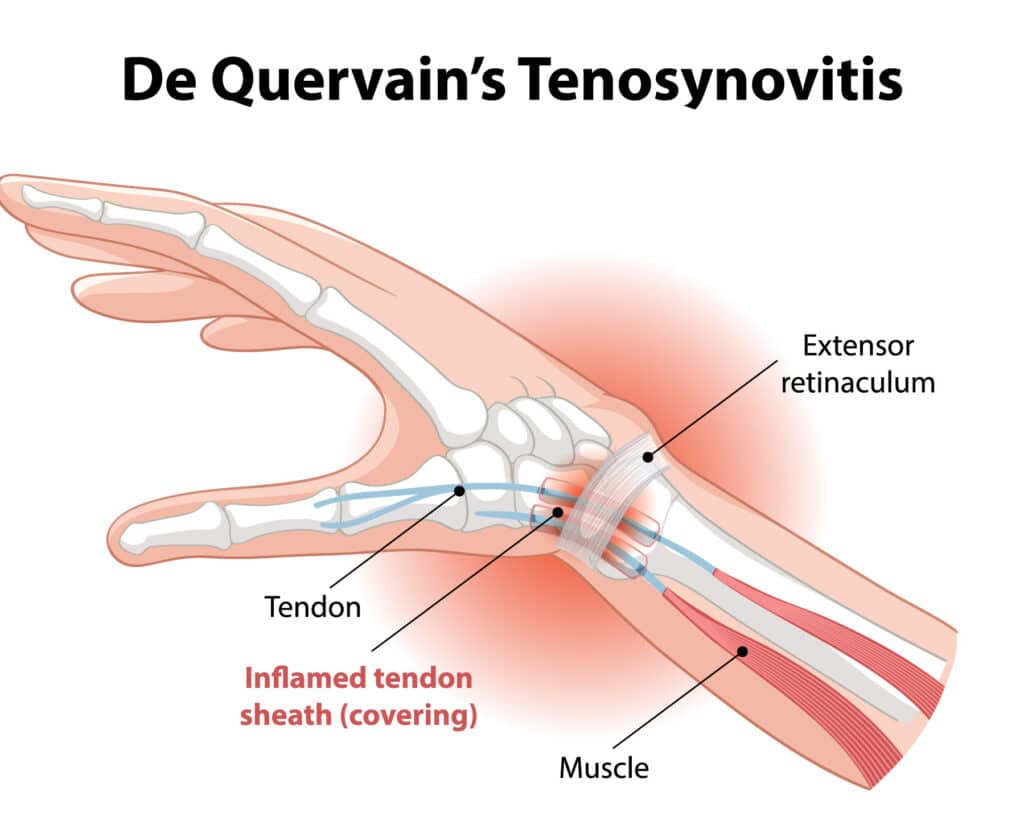 dequervain-poa - Princeton Orthopaedic Associates