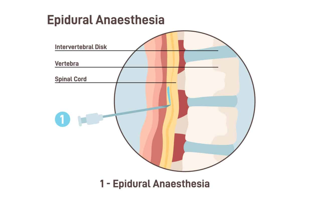 Rss Injection Lumbar Epidural Injections: What to Expect - Princeton Orthopaedic ...