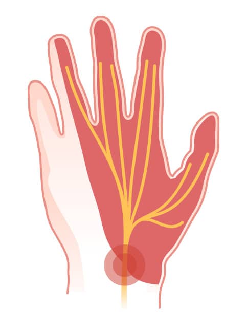 fingers-poa - Princeton Orthopaedic Associates