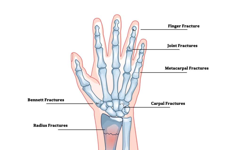 fractures-poa - Princeton Orthopaedic Associates