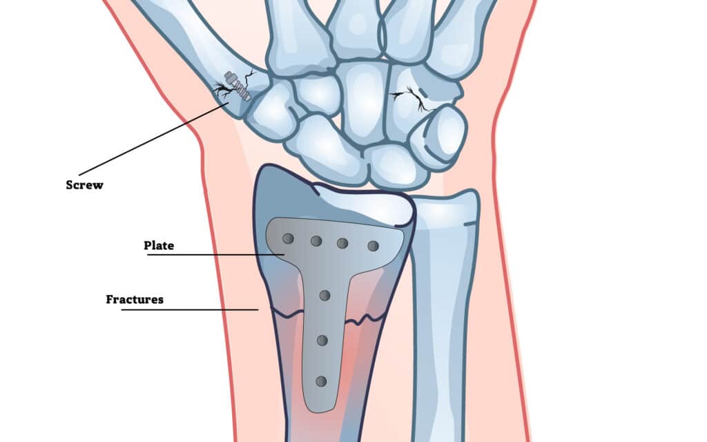 fractures-poa-fix - Princeton Orthopaedic Associates