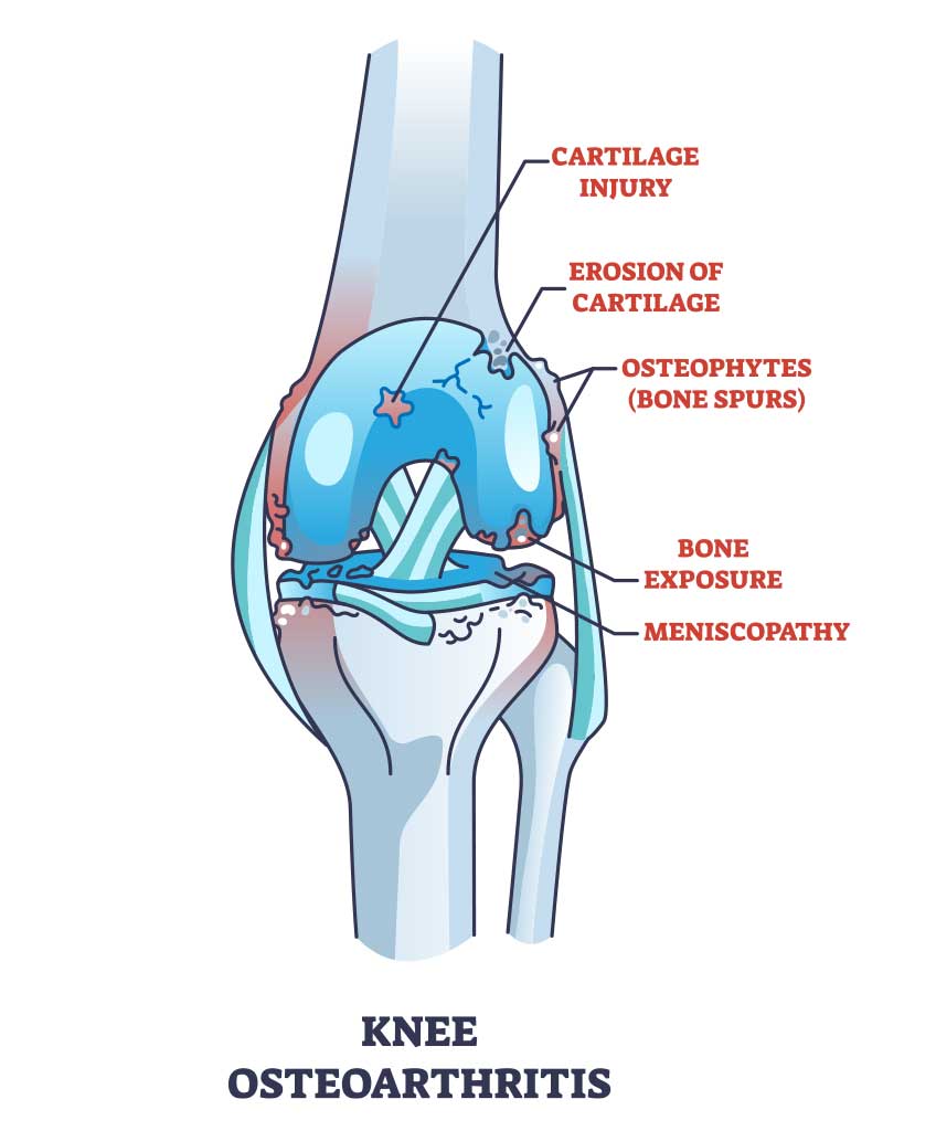 knee-asteoartritis-poa - Princeton Orthopaedic Associates