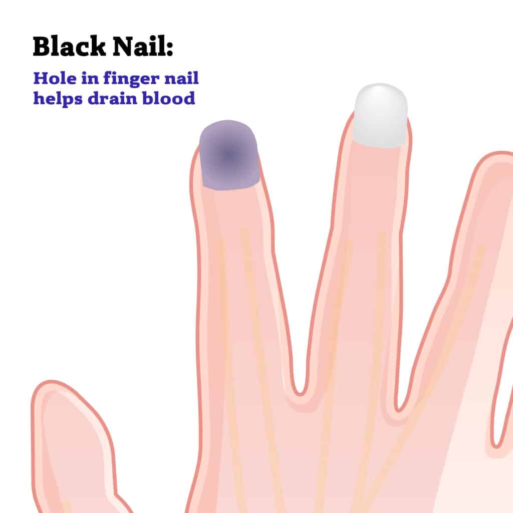 poa-blacknail - Princeton Orthopaedic Associates