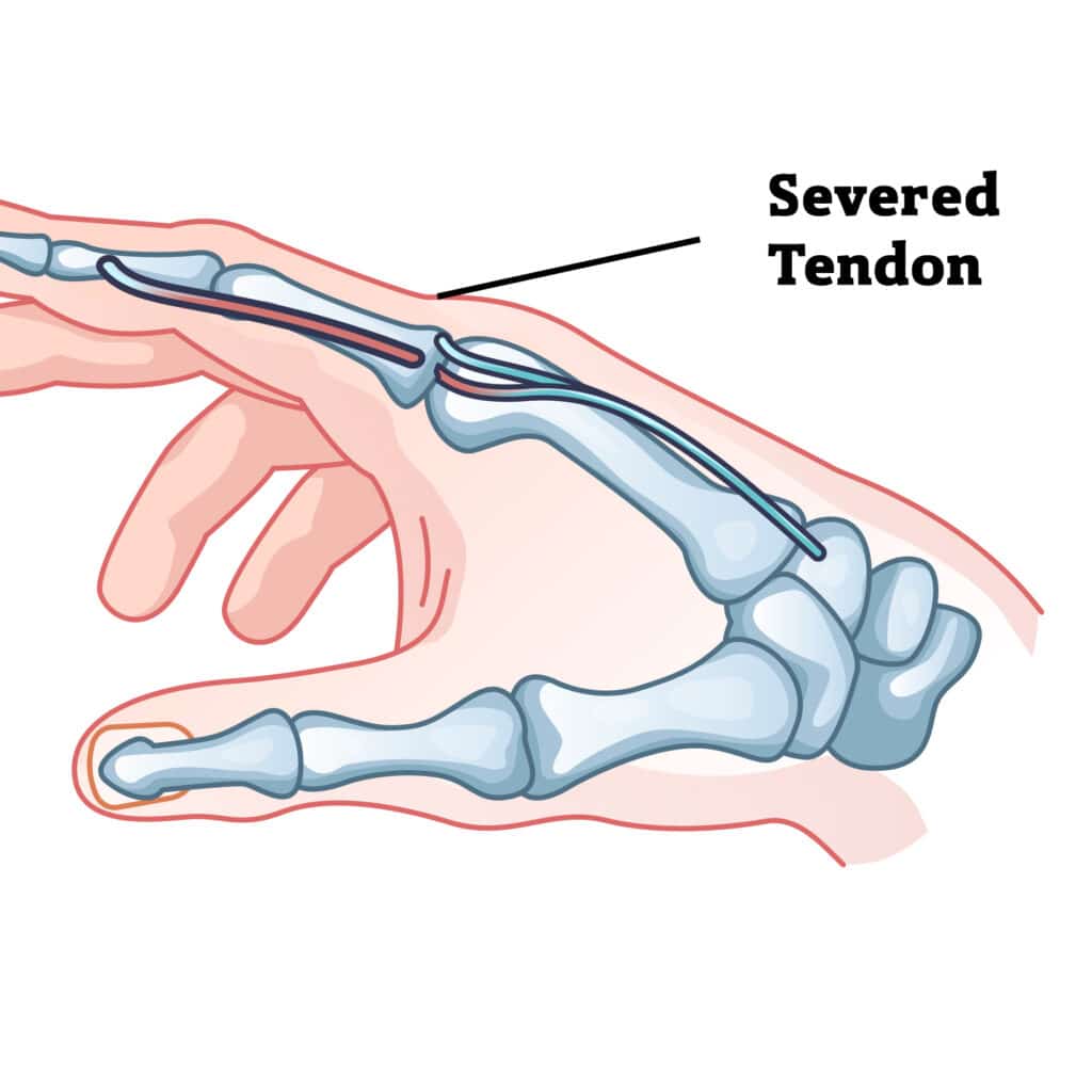 poa-severed-tendon - Princeton Orthopaedic Associates