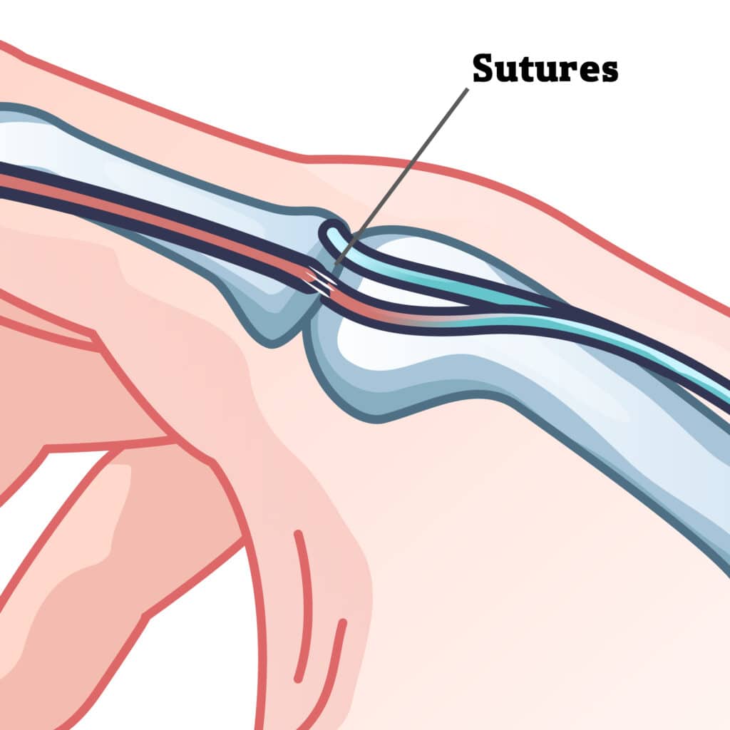 poa-severed-tendon-sutures - Princeton Orthopaedic Associates