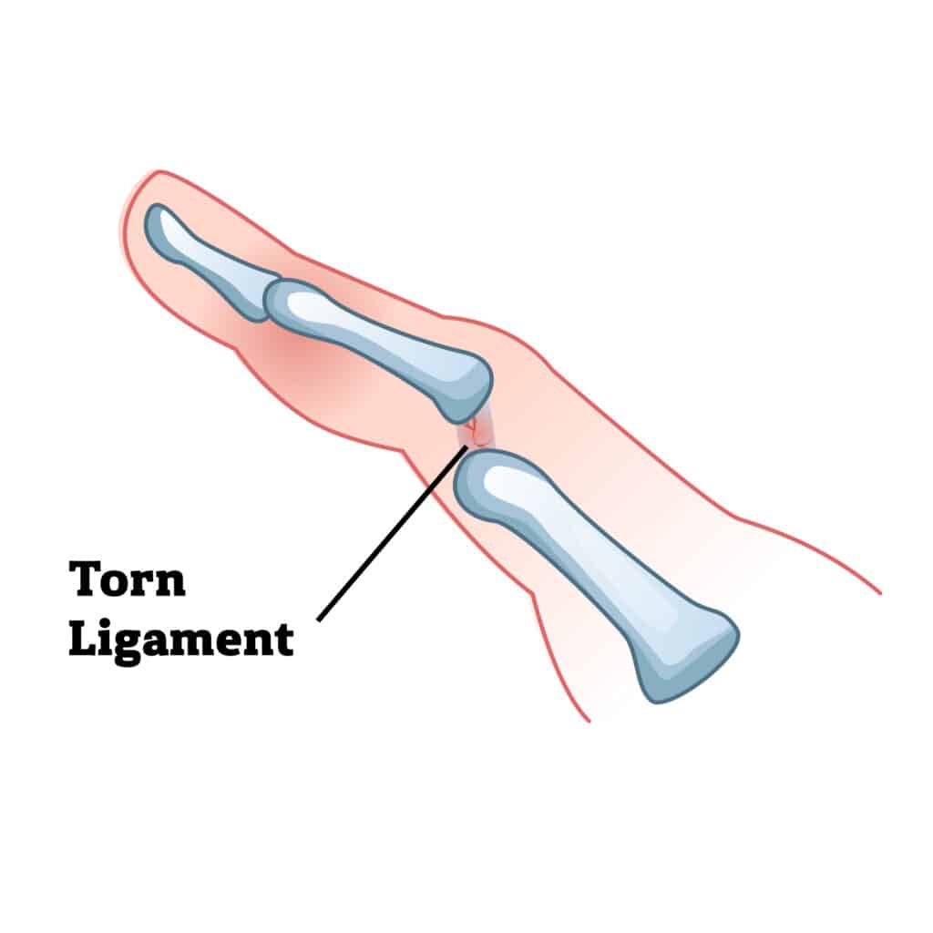 torn-ligament-poa - Princeton Orthopaedic Associates