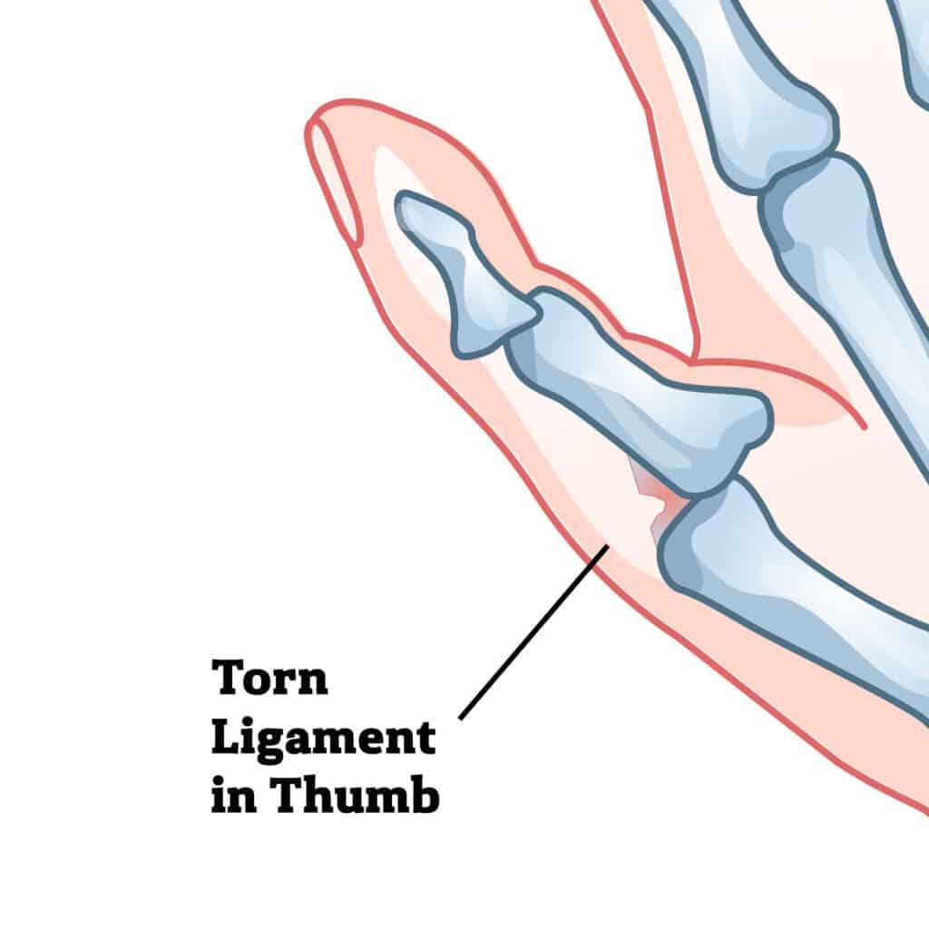 torn-thumb-ligament-poa - Princeton Orthopaedic Associates