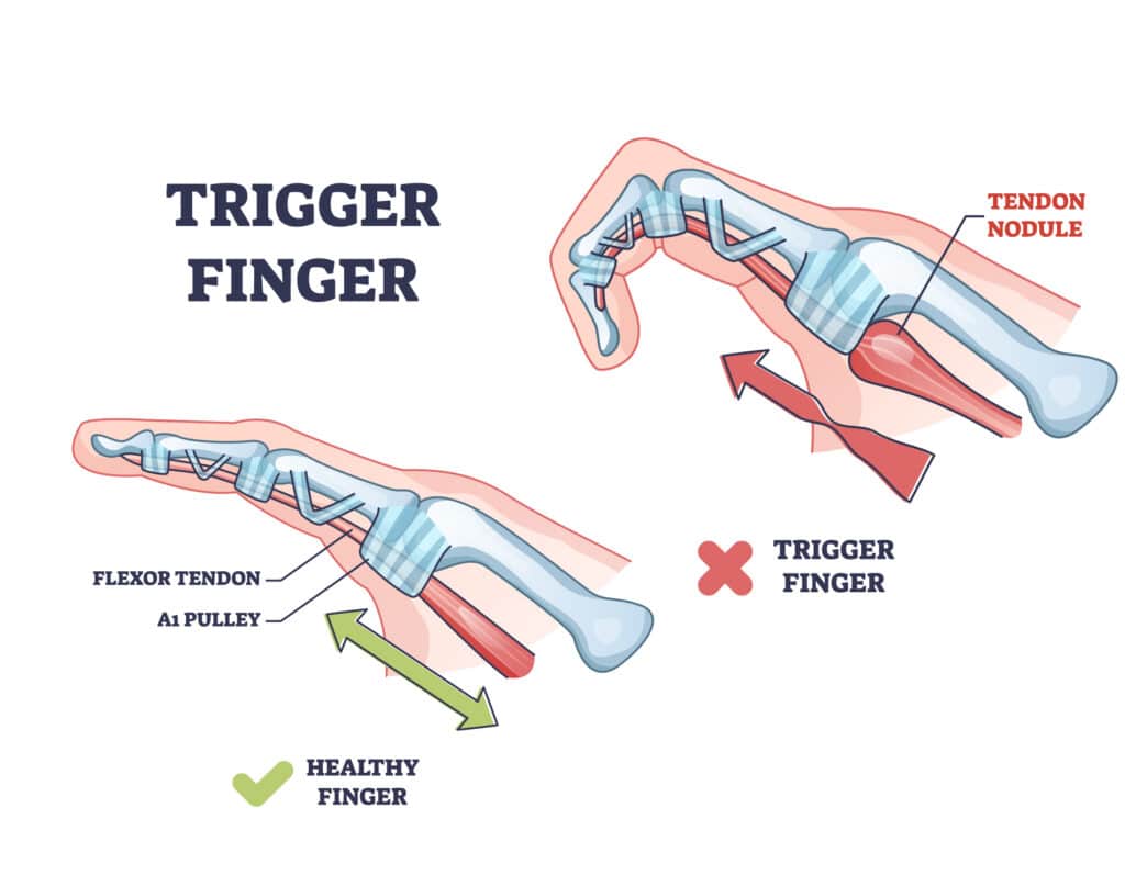 trigger-finger-poa - Princeton Orthopaedic Associates