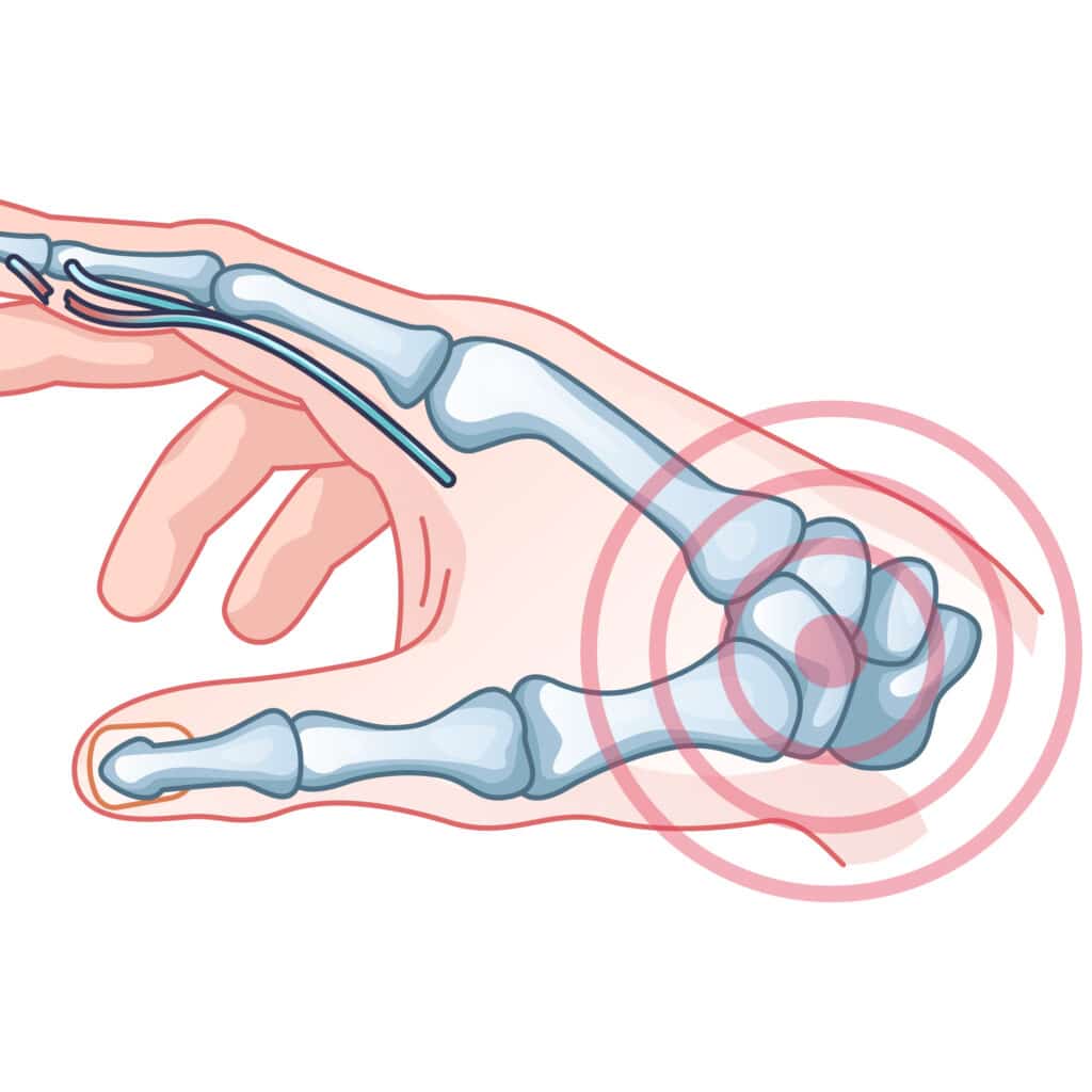 wrist-sprain-poa - Princeton Orthopaedic Associates