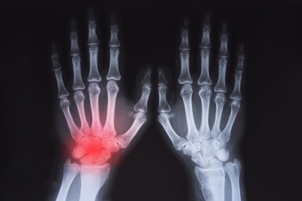 HumansHandsXRayHighlightedInRed - Princeton Orthopaedic Associates