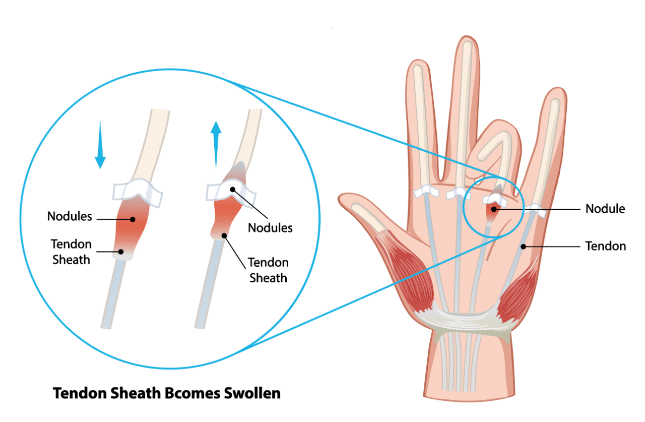 Trigger Finger: Symptoms, Causes, and Treatments - Princeton ...