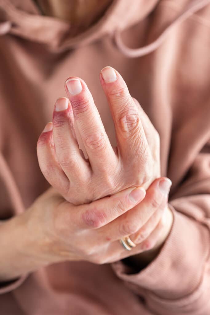 Woman hands with atopic dermatitis eczema allergy reaction on skin - Princeton Orthopaedic Associates Close-up of a person’s hands clasped together, fingers interlaced, wearing a pinkish sweater.